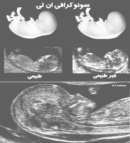 سونوگرافی ان تی