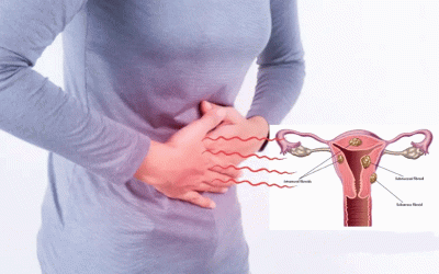 درمان فیبروم رحم