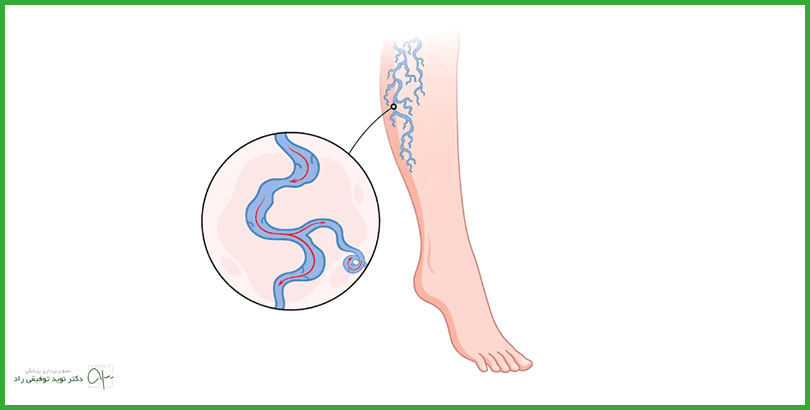 نحوه انجام اسکلروتراپی