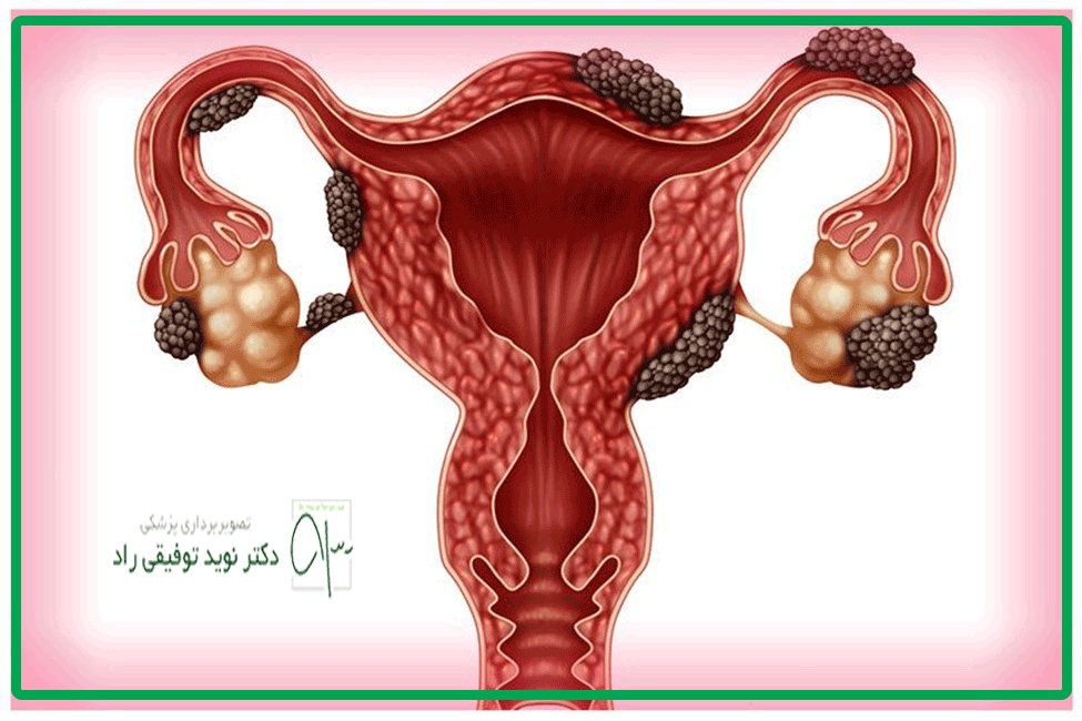 آندومتريوز جدار شكم