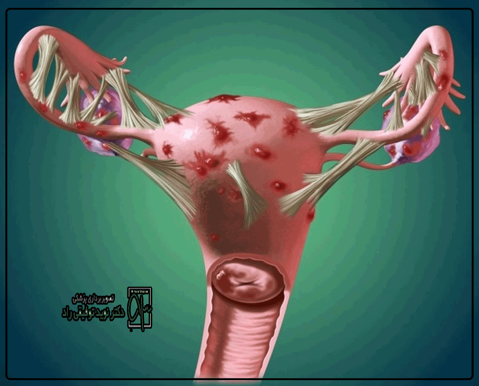 آندومتريوز جدار شكم با مایكروويو