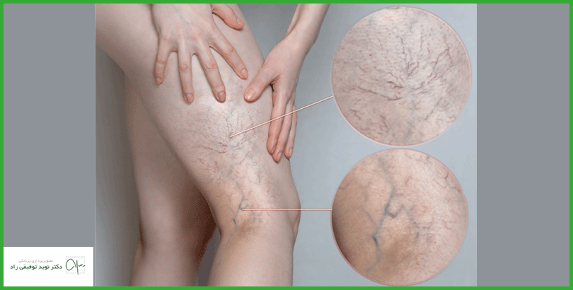 اسکلروتراپی