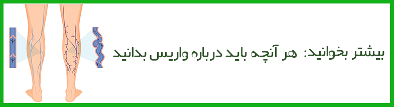 انواع واریس چیست؟